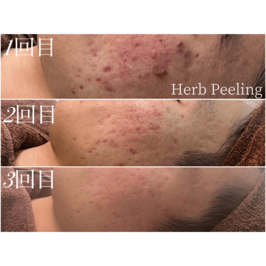 ハーブピーリング