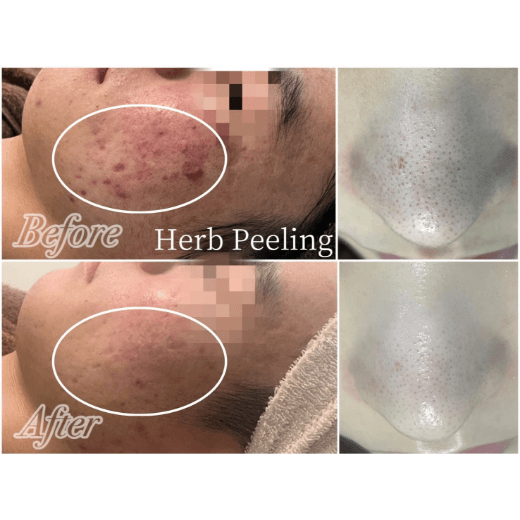 ハーブピーリング