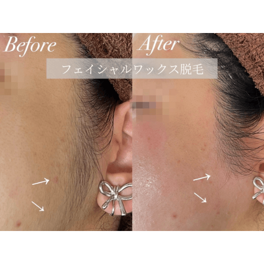 フェイシャルワックス脱毛