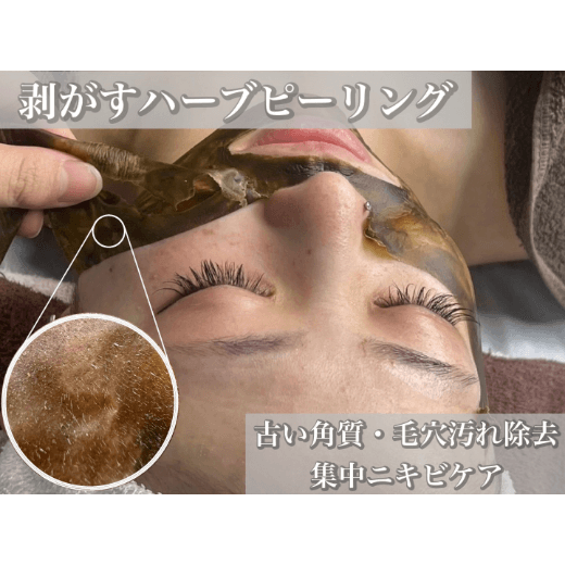 剥がすハーブピーリング 古い角質・毛穴汚れ除去 集中ニキビケア